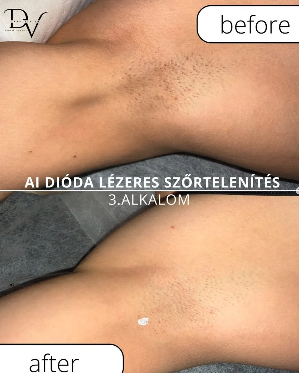 Lézeres szőrtelenítés előtte és utána
